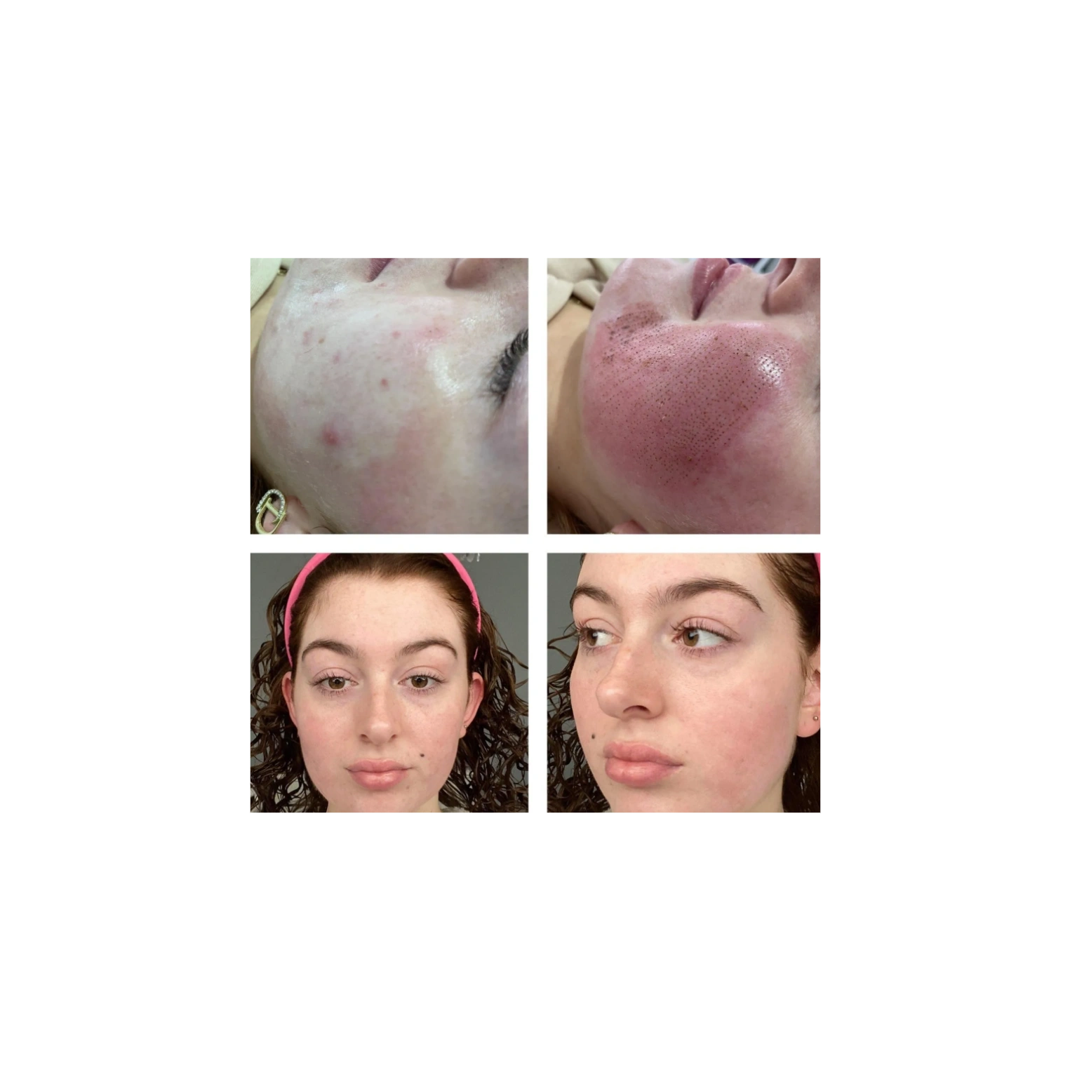 Plasma fibroblast Acne skin