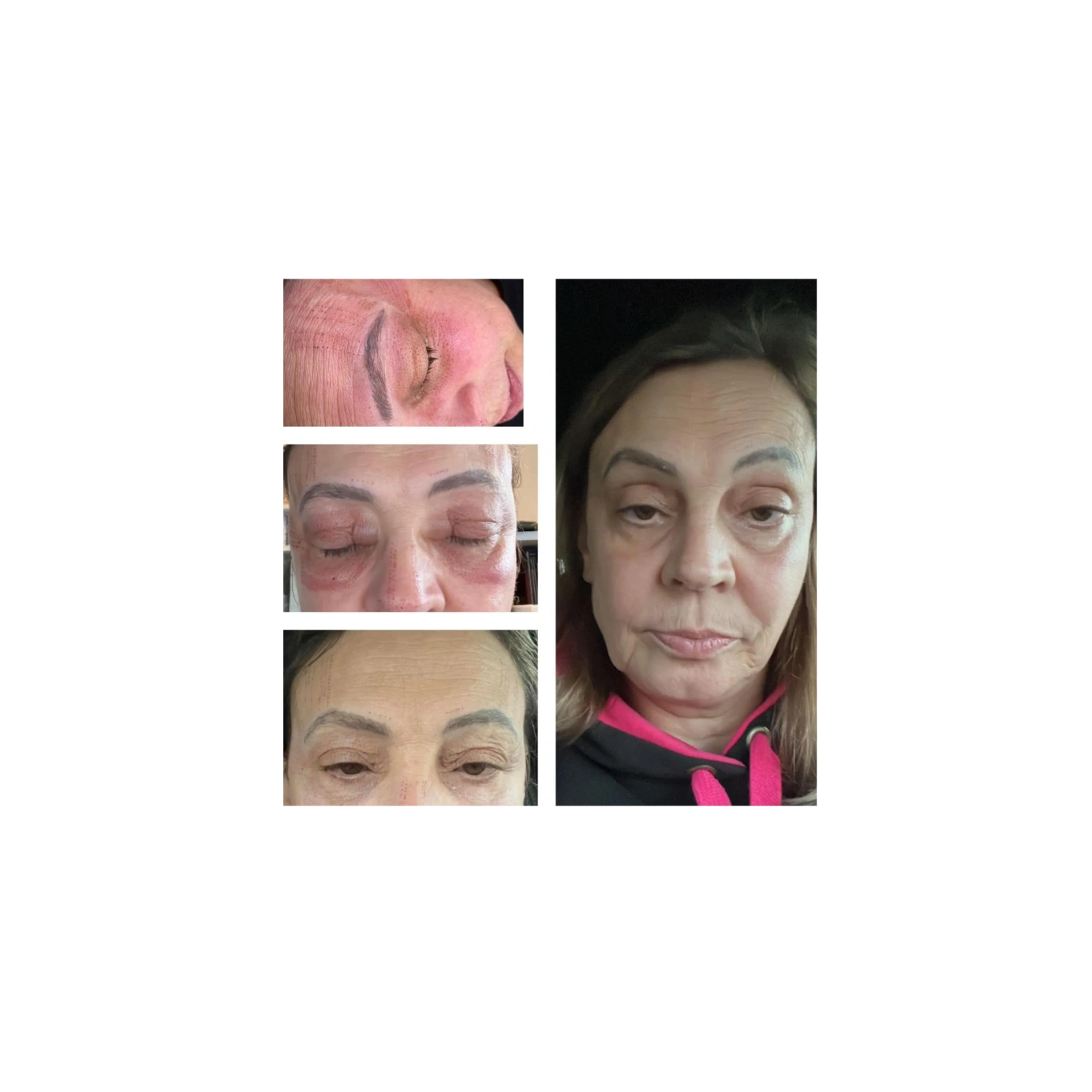 Plasma fibroblast on eyelids