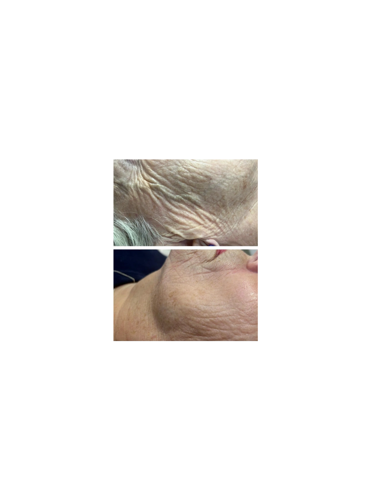 Plasma fibroblast on wrinkles